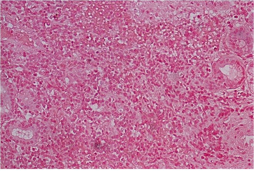 Figure 11. Right ethmoid sinus, EBER negative, 20x